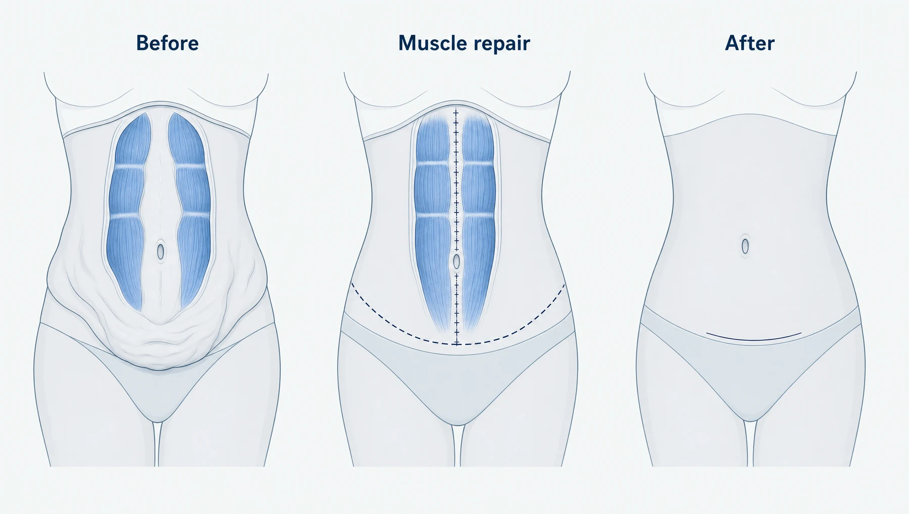 Diagram in three panels: separated abdominal muscles and loose skin before surgery, the muscles stitched together with excess skin marked for removal, and the flatter result with a low scar
